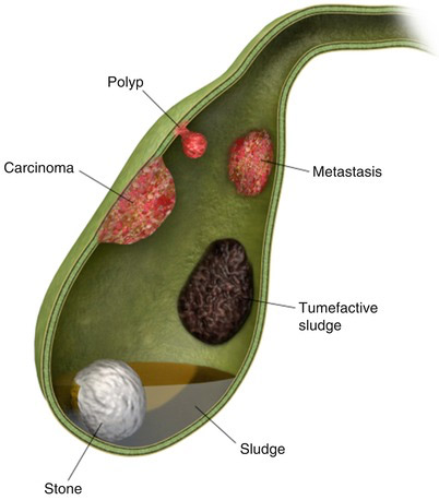 Cancer Vesicula