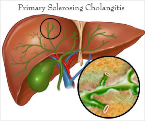 servicos-colangite-esclerosante-primaria